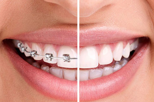 https://www.dentalspecialitycentre.co.in/wp-content/uploads/2025/04/4-dental-health-problems-that-can-be-fixed-by-orthodontic-treatment-L-1.jpg
