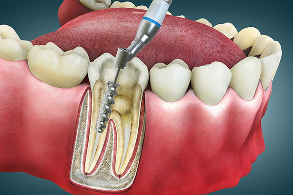 https://www.dentalspecialitycentre.co.in/wp-content/uploads/2025/04/Root-Canal-Treatment.jpg