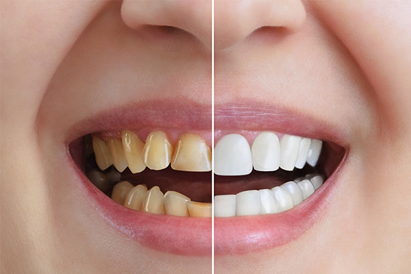 https://www.dentalspecialitycentre.co.in/wp-content/uploads/2025/04/Teeth-Whitening.jpg