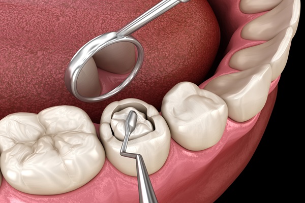 https://www.dentalspecialitycentre.co.in/wp-content/uploads/2025/04/dental-filling-2401.jpg
