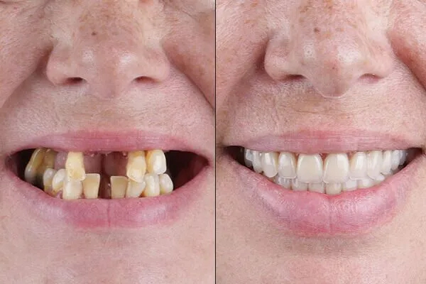 https://www.dentalspecialitycentre.co.in/wp-content/uploads/2025/04/full-mouth-rehabilitation.jpg