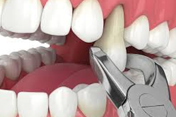https://www.dentalspecialitycentre.co.in/wp-content/uploads/2025/04/surgical-extraction.jpg