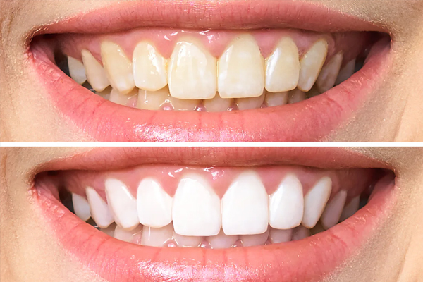https://www.dentalspecialitycentre.co.in/wp-content/uploads/2025/05/Bleaching.jpg