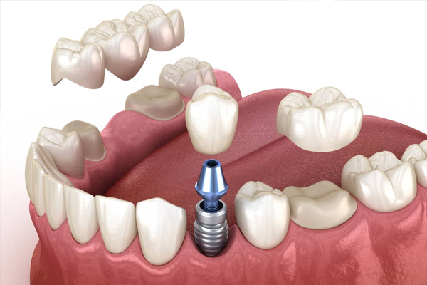 https://www.dentalspecialitycentre.co.in/wp-content/uploads/2025/05/Crown-Bridges.jpg