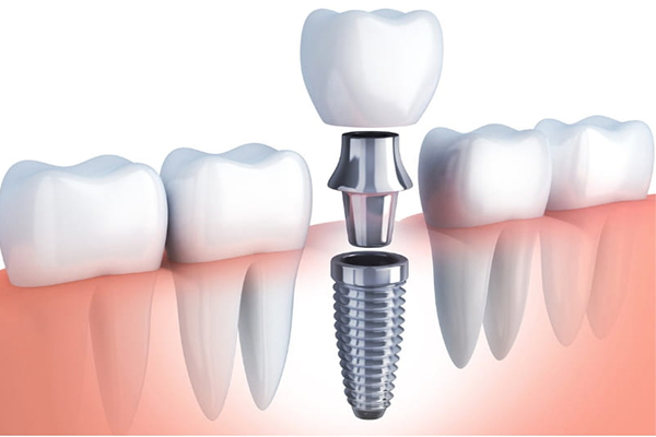 https://www.dentalspecialitycentre.co.in/wp-content/uploads/2025/05/Dental-Implants.jpg