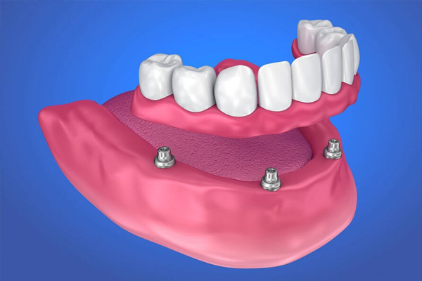 https://www.dentalspecialitycentre.co.in/wp-content/uploads/2025/05/Dentures.jpg