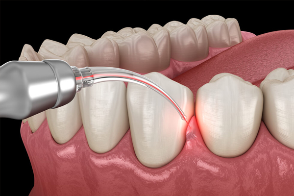 https://www.dentalspecialitycentre.co.in/wp-content/uploads/2025/05/Gums-Surgeries.jpg