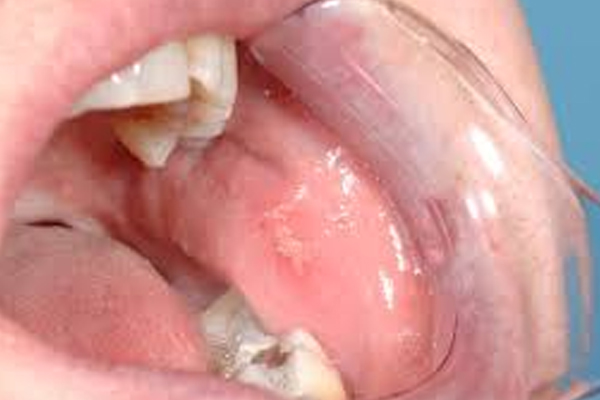 https://www.dentalspecialitycentre.co.in/wp-content/uploads/2025/05/Oral-Lesions-Treatment.jpg