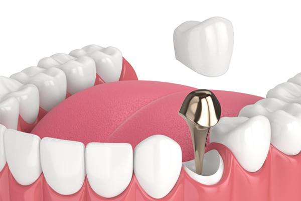 https://www.dentalspecialitycentre.co.in/wp-content/uploads/2025/05/Post-Core-Treatment.jpg