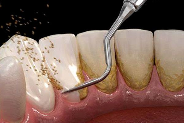 https://www.dentalspecialitycentre.co.in/wp-content/uploads/2025/05/Scaling-Polishing.jpg