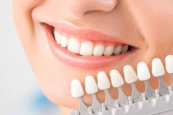 https://www.dentalspecialitycentre.co.in/wp-content/uploads/2025/05/Veneer-Laminate.jpg